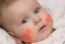 Photo of ¿Existe relación entre la enfermedad infantil de Kawasaki y el coronavirus?